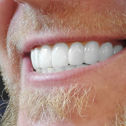 EasySmile | Carillas dentales de cerámica adaptables